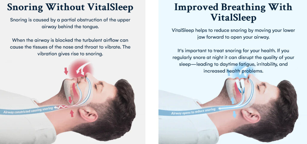 What are the benefits of using anti-snoring Vitalsleep device?