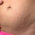 what cream is good for stretch marks