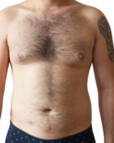 Gynecomastia vs Fat: Do I Have Gynecomastia or Chest Fat?