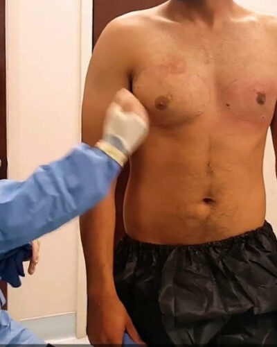 The Best Way to Get Rid of Gynecomastia Surgery Scars