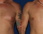 Gynecomastia Surgery Cost