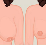 Breast Reduction Surgery Near Me