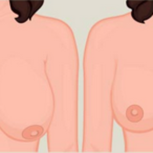 How Can I Find Breast Reduction Surgery Near Me?