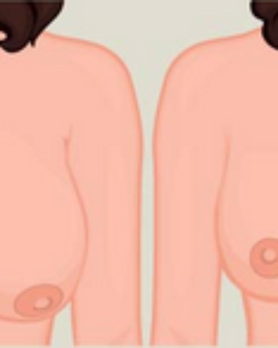 How Can I Find Breast Reduction Surgery Near Me?