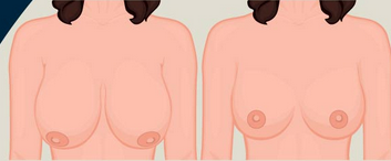 How to get smaller breasts