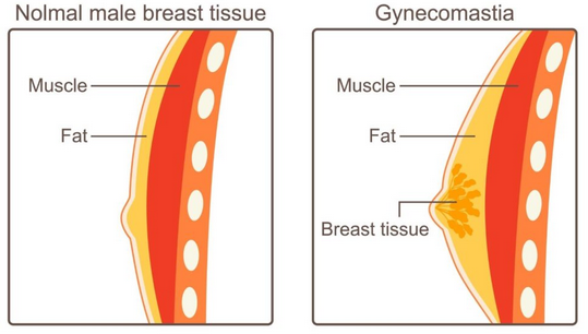 Gynecomastia Pinch Test 
