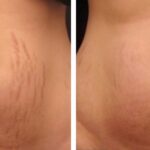 Stretch Mark Therapy Cream