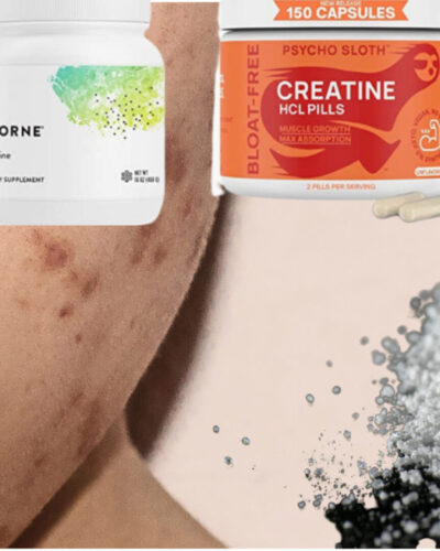 Does Creatine Cause Acne: All You Need To Know