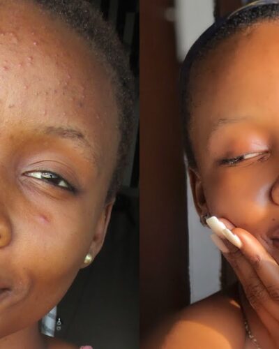 Acne Scars Before and After Using Illuminatural 6i Cream