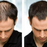 What Is the Best Treatment for Hair Loss and Thinning?