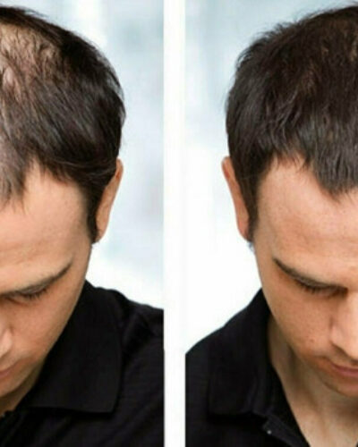 What Is the Best Treatment for Hair Loss and Thinning?