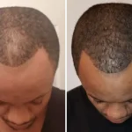 Best Hair Loss Treatment For Black Males