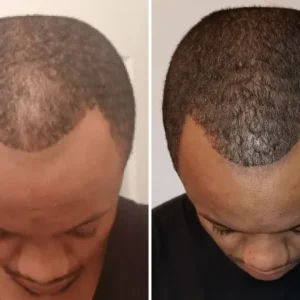 The Best Hair Loss Treatment for Black Males