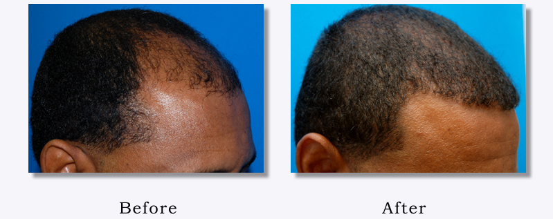 Best Hair Loss Treatment for Black Males