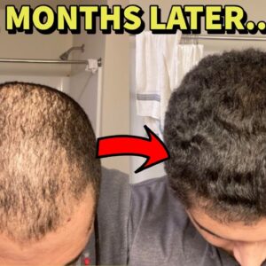 The Best Treatment for Hair Loss for Men