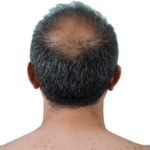 Profollica Hair Loss Treatment