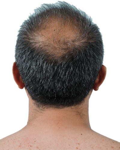 Profollica Hair Loss Treatment Reviews