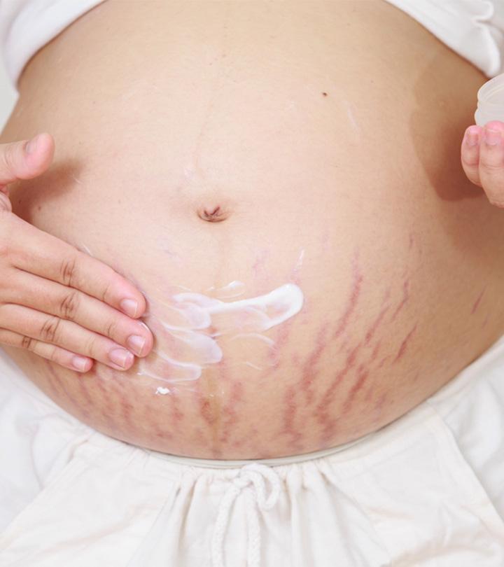 How To Get Rid Of Stretch Marks On Stomach After Pregnancy