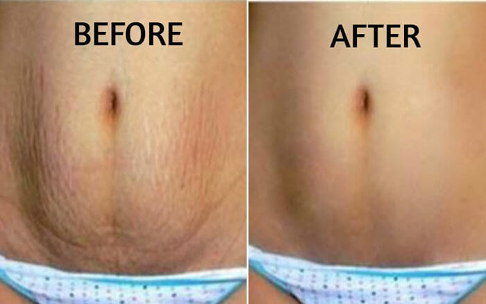 How To Get Rid Of Stretch Marks On Stomach After Pregnancy