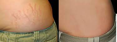 Skinception Intensive Stretch Mark Therapy Reviews